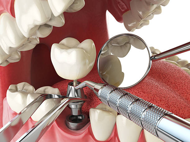Teeth Whitening in VA